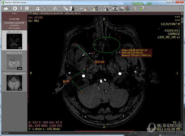 RadiAnt DICOM Viewer